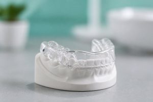 Gutieră transparentă de noapte pe model dentar, pentru bruxism