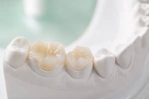 Incrustații ceramice inlay pe model dentar