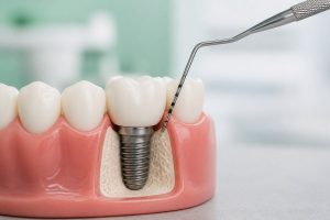 Sondă parodontală lângă un implant dentar pe model cu gingie