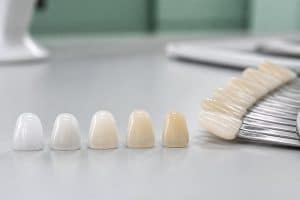 Coroane și fațete ceramice în nuanțe diferite, lângă cheia de culori