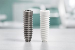 Comparație între un implant din titan și unul din zirconiu